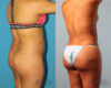Brazilian Butt Lift case #4823 slider thumbnail