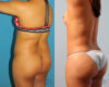 Brazilian Butt Lift case #4823 slider thumbnail