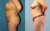 Tummy Tuck case #7342 slider thumbnail