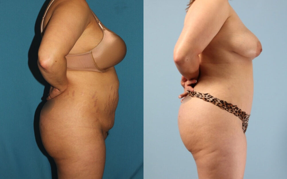 Tummy Tuck case #7342