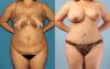 Tummy Tuck case #7342 slider thumbnail