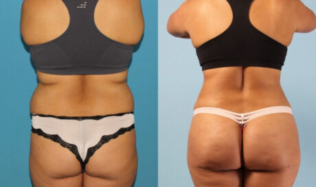 Brazilian Butt Lift case #4902