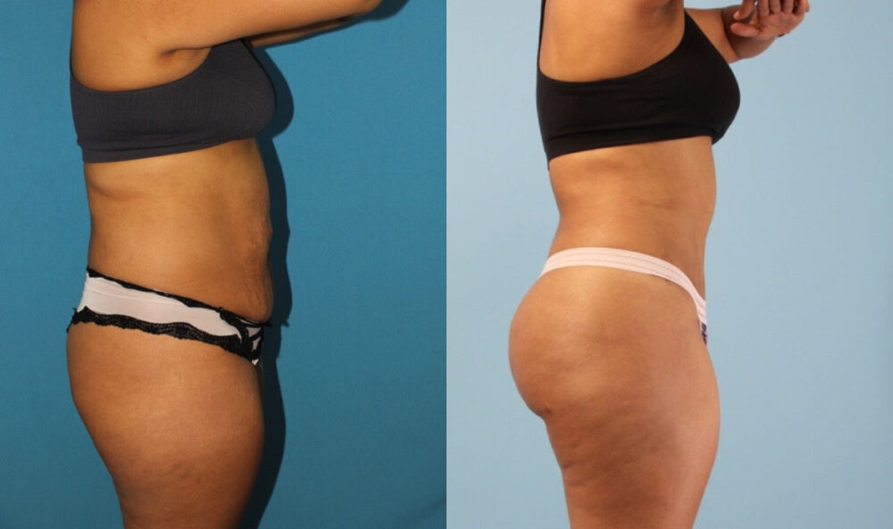 Brazilian Butt Lift case #4902