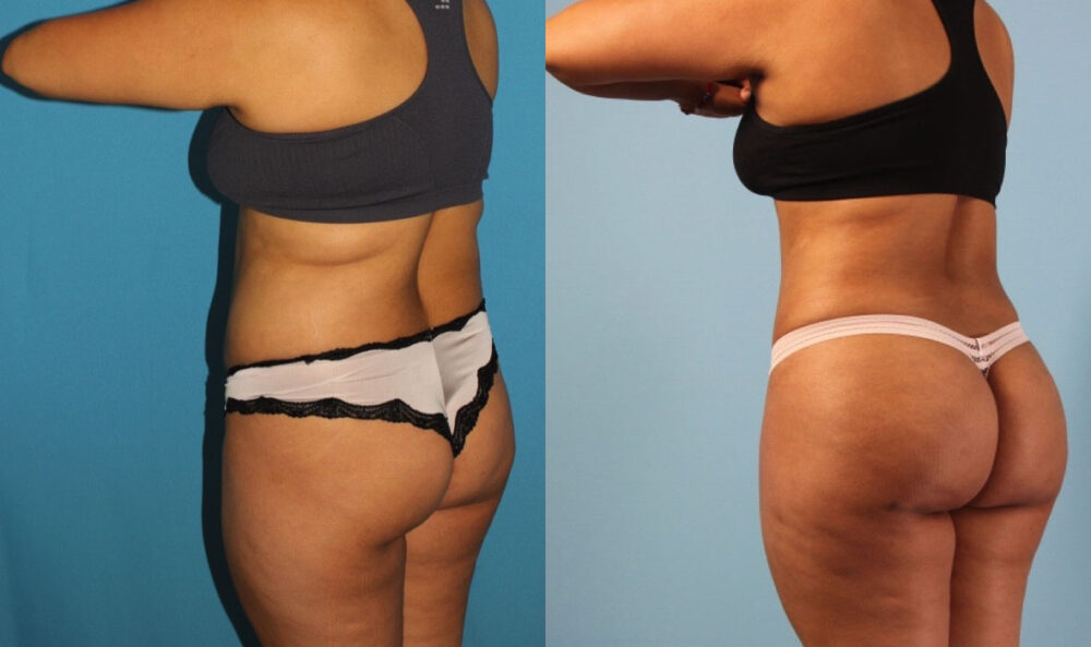 Brazilian Butt Lift case #4902