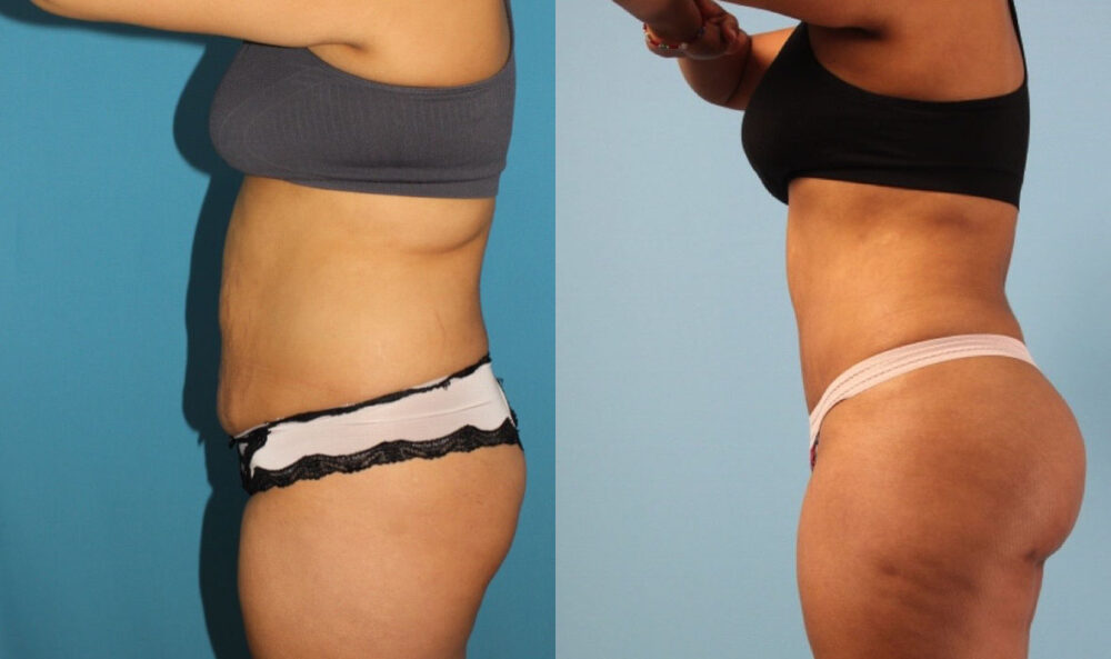 Brazilian Butt Lift case #4902