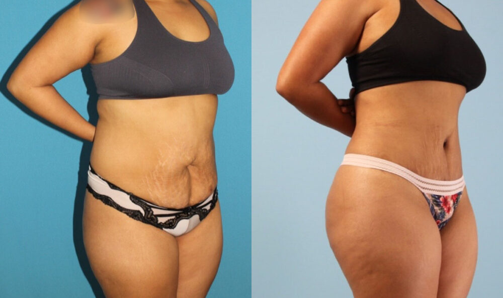 Brazilian Butt Lift case #4902