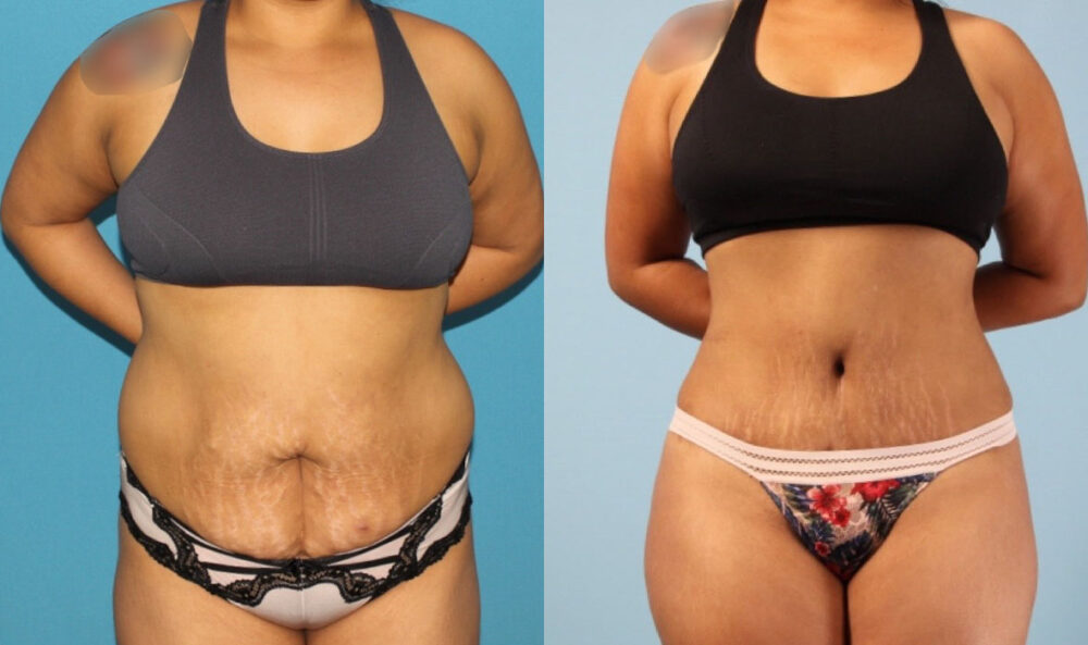 Brazilian Butt Lift case #4902