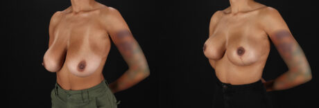 Breast Reduction case #8025