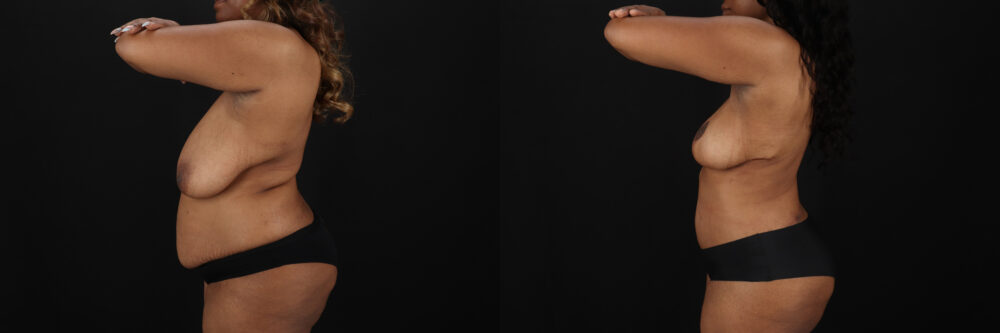 Post Bariatric Surgery (Massive Weight Loss) case #6782