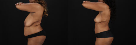 Post Bariatric Surgery (Massive Weight Loss) case #6782