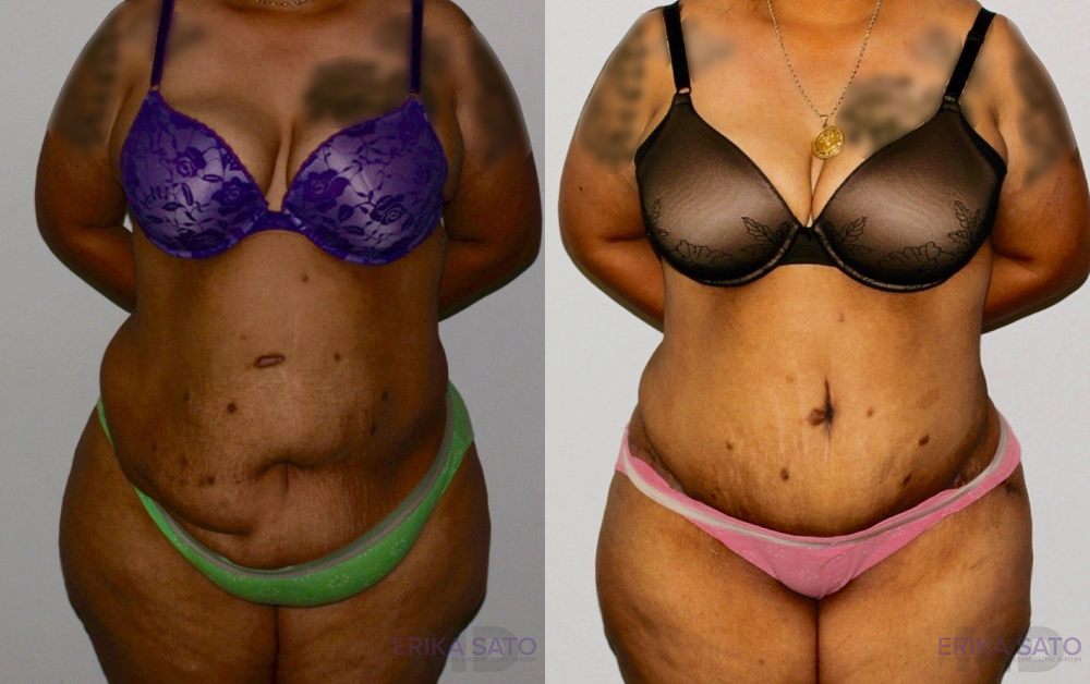 Post Bariatric Surgery (Massive Weight Loss) case #6773