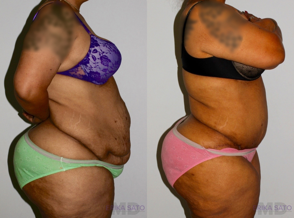 Post Bariatric Surgery (Massive Weight Loss) case #6773