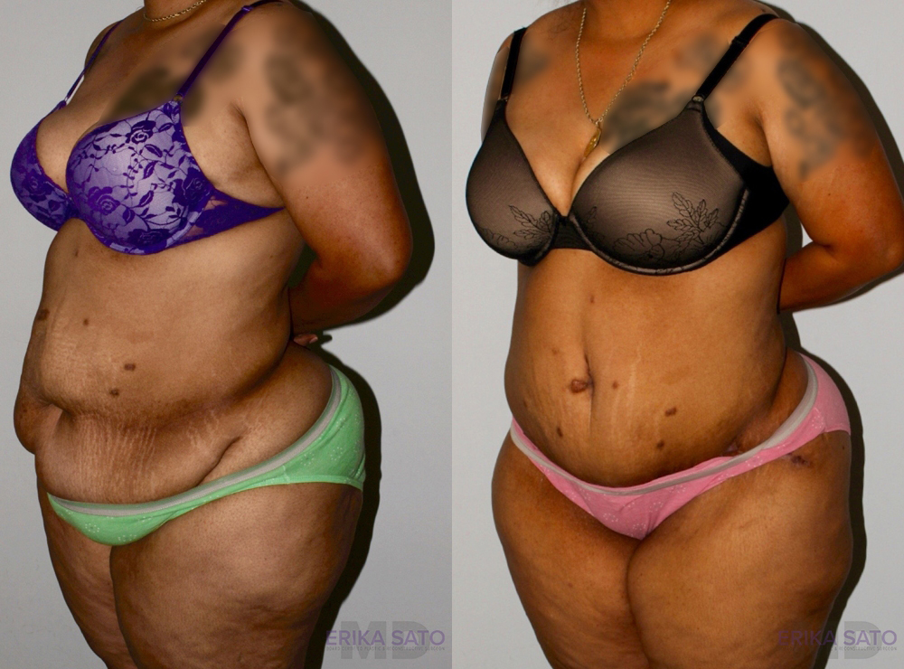 Post Bariatric Surgery (Massive Weight Loss) case #6773