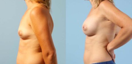Breast Augmentation case #6303