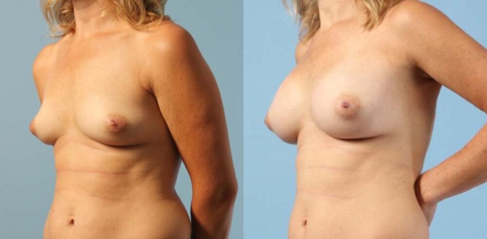 Breast Augmentation case #6303