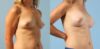 Breast Augmentation case #6303 slider thumbnail