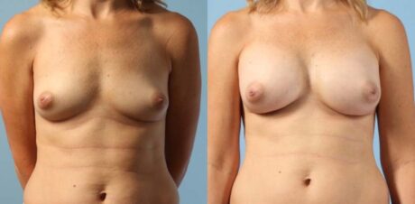 Breast Augmentation case #6303