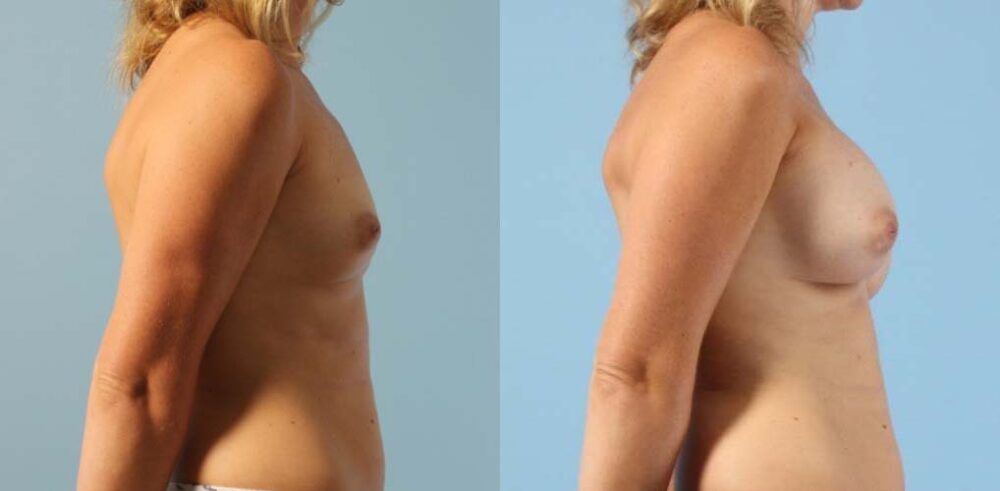 Breast Augmentation case #6303