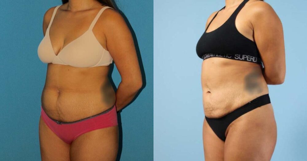 Liposuction case #5967