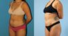 Liposuction case #5967 slider thumbnail