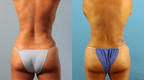 Fat Grafting to the Breast case #256180