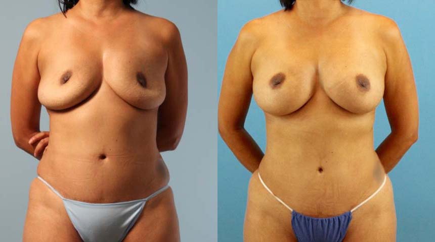 Implant Removal case #258479