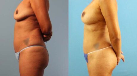 Implant Removal case #258479