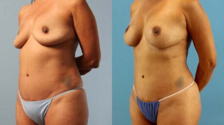 Implant Removal case #258479