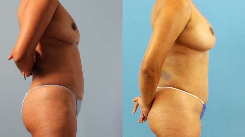 Implant Removal case #258479