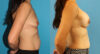 Breast Augmentation case #6309 slider thumbnail