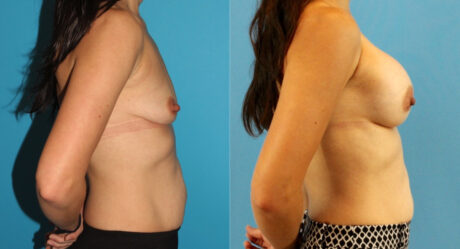 Breast Augmentation case #6309