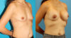 Breast Augmentation case #6309 slider thumbnail