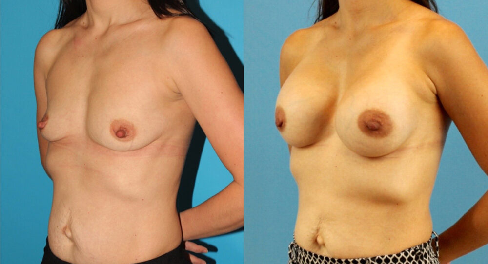 Breast Augmentation case #6309