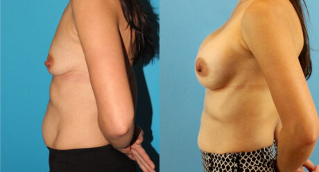 Breast Augmentation case #6309