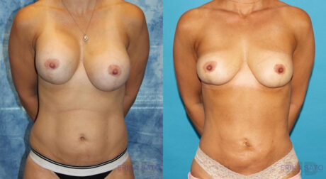 Implant Removal case #258481