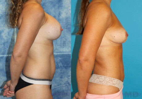 Implant Removal case #258481