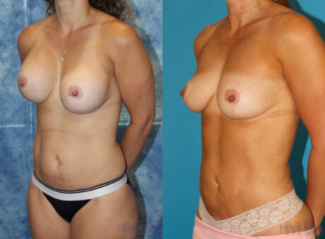 Implant Removal case #258481