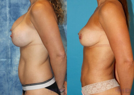 Implant Removal case #258481