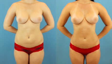 Brazilian Butt Lift case #4905