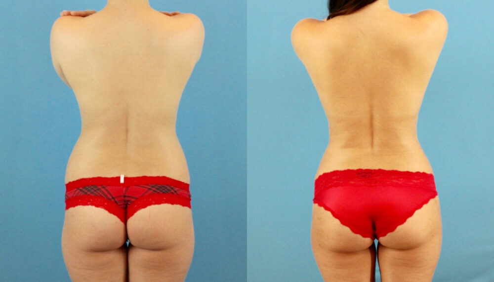 Brazilian Butt Lift case #4905