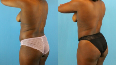 Brazilian Butt Lift case #4904