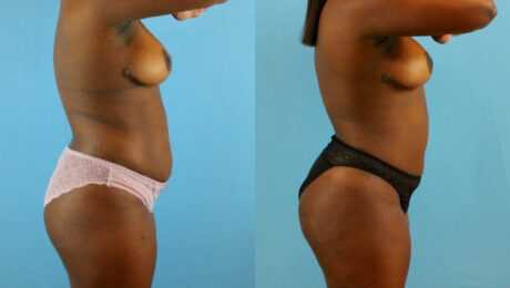 Brazilian Butt Lift case #4904