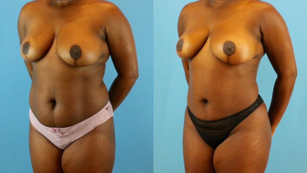 Brazilian Butt Lift case #4904