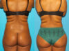 Brazilian Butt Lift case #4906 slider thumbnail