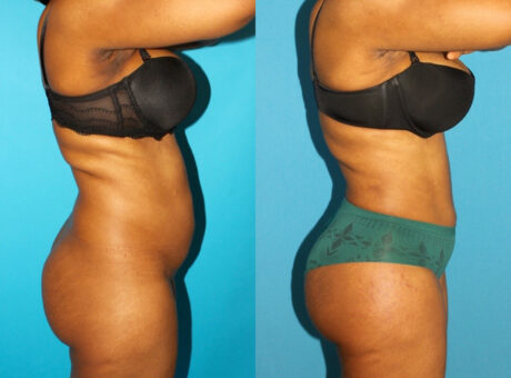 Brazilian Butt Lift case #4906