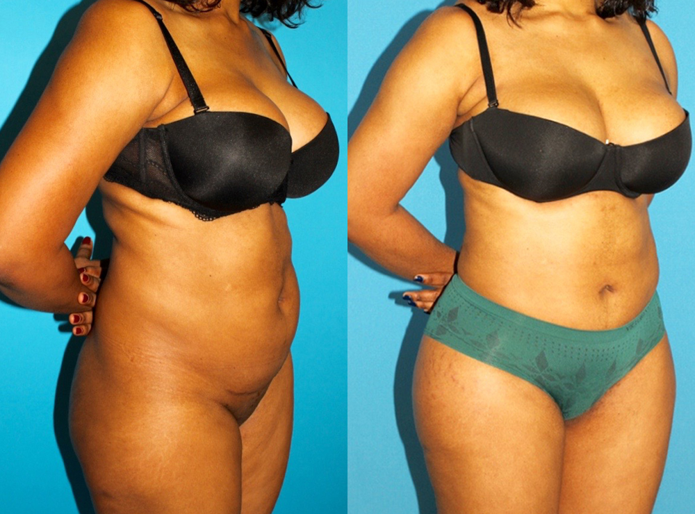 Brazilian Butt Lift case #4906