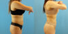 Liposuction case #6008 slider thumbnail