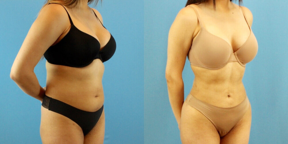 Liposuction case #6008