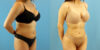 Liposuction case #6008 slider thumbnail