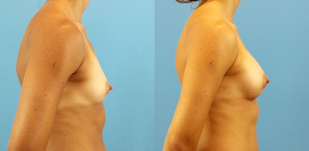 Breast Augmentation case #6315